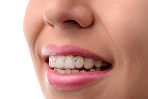 Wide Range of Invisalign Options Affordable Invisalign in Stamford